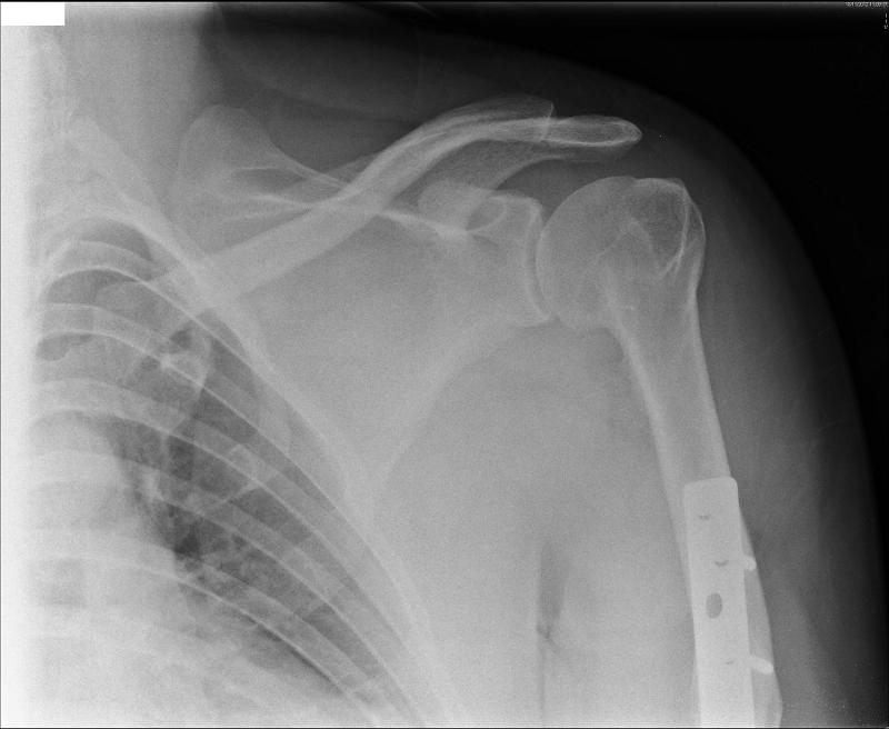 xray 1