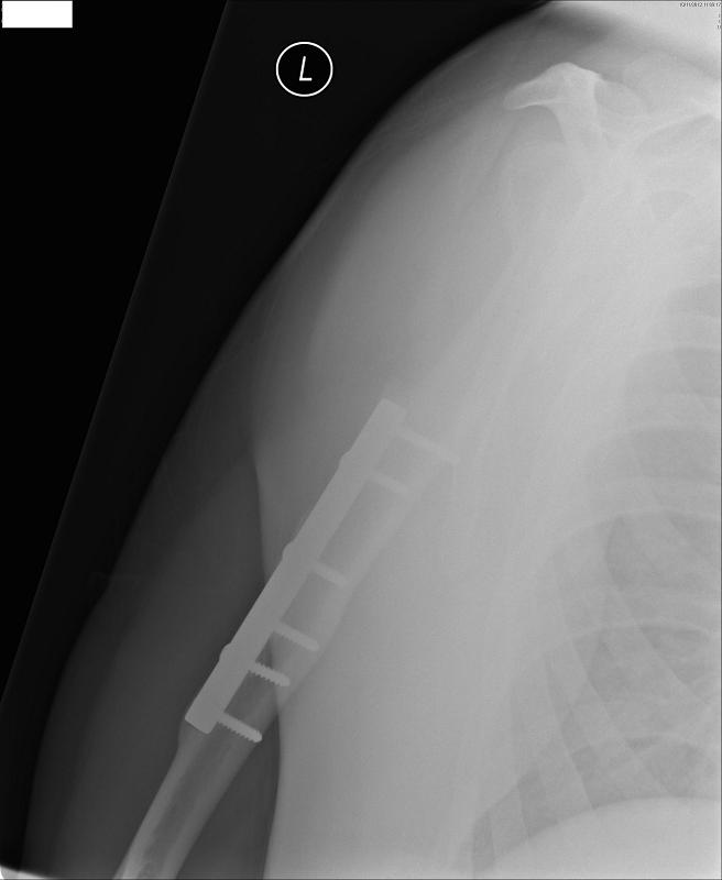 xray 2
