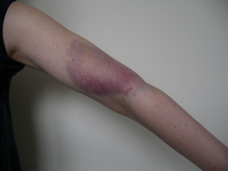 Bruised Arm