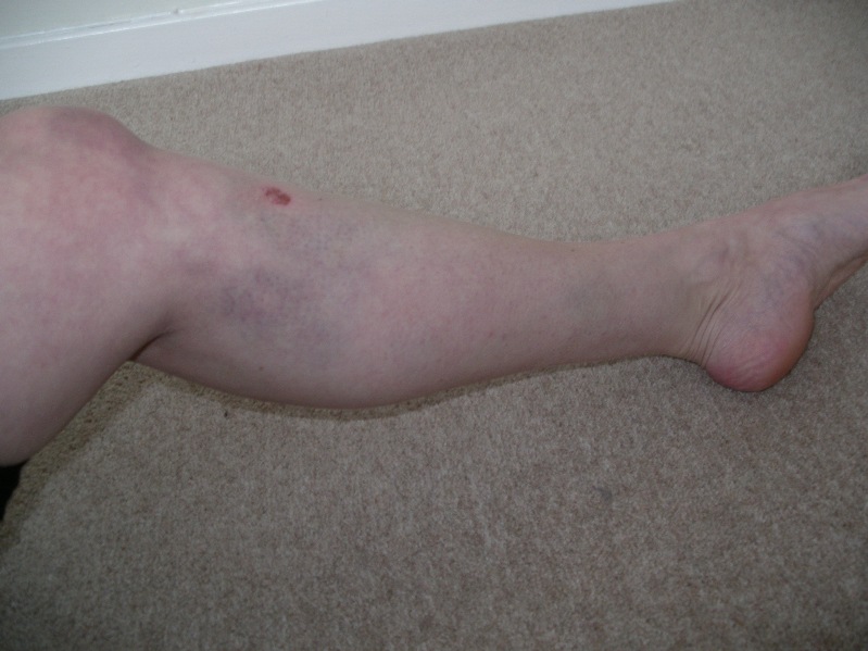 Bruised Leg